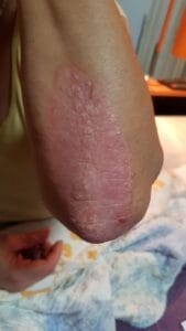 Evolución de Placa de Psoriasis después de aplicación de Crema Regeneradora Corporal Neothalys 3 días
