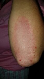 Evolución de Placa de Psoriasis después de aplicación de Crema Regeneradora Corporal Neothalys 6 días