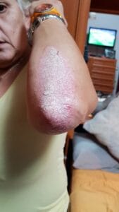 Evolución de Placa de Psoriasis después de aplicación de Crema Regeneradora Corporal Neothalys 1 día