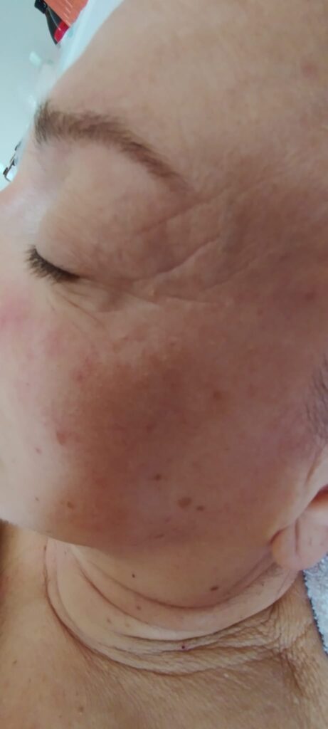 Antes y después real de aplicación de factores de crecimiento con dermapen
