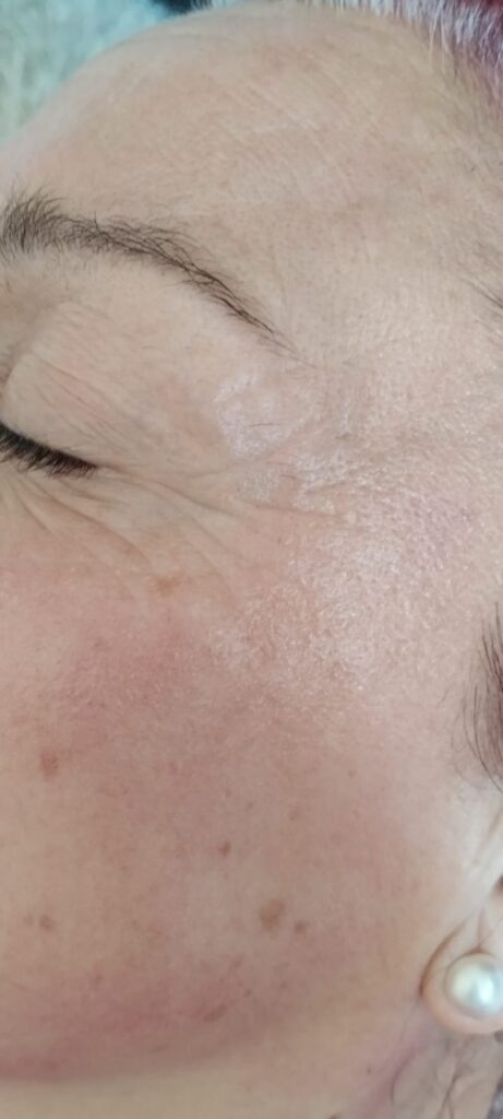 Antes y después real de aplicación de factores de crecimiento con dermapen 2