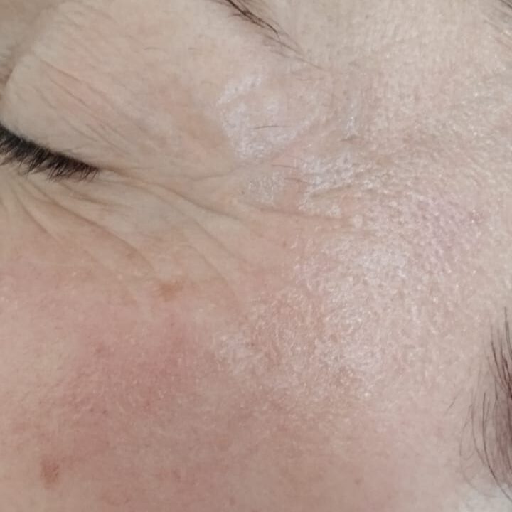 Antes y después real de aplicación de factores de crecimiento con dermapen 2